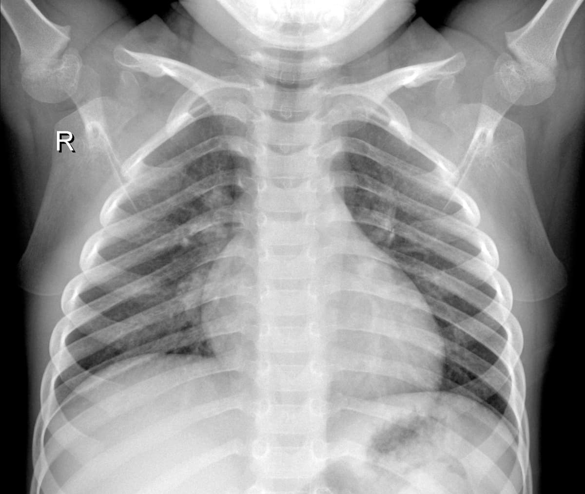 Radiografia Normal — NIH Chest X-ray14