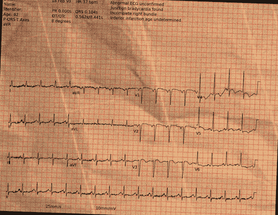Normal ECG — PTB-XL
