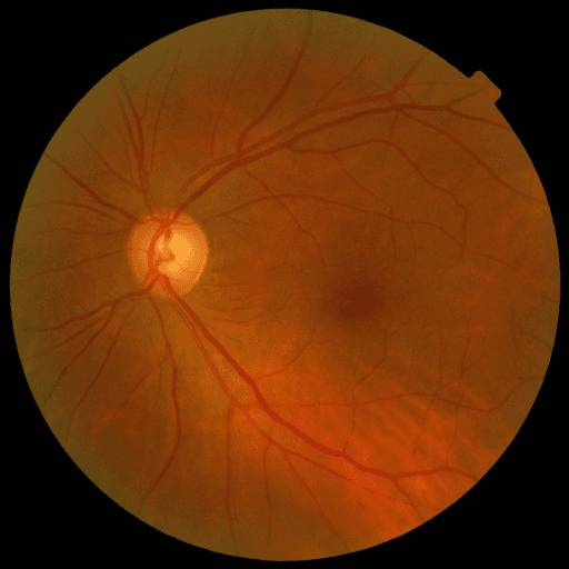 No Diabetic Retinopathy — MESSIDOR-2