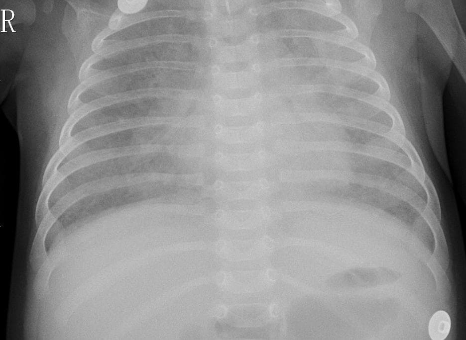 Pneumonia — NIH Chest X-ray14