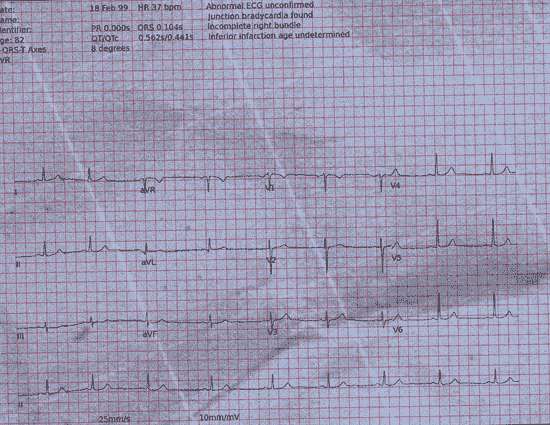 Normal ECG — PTB-XL