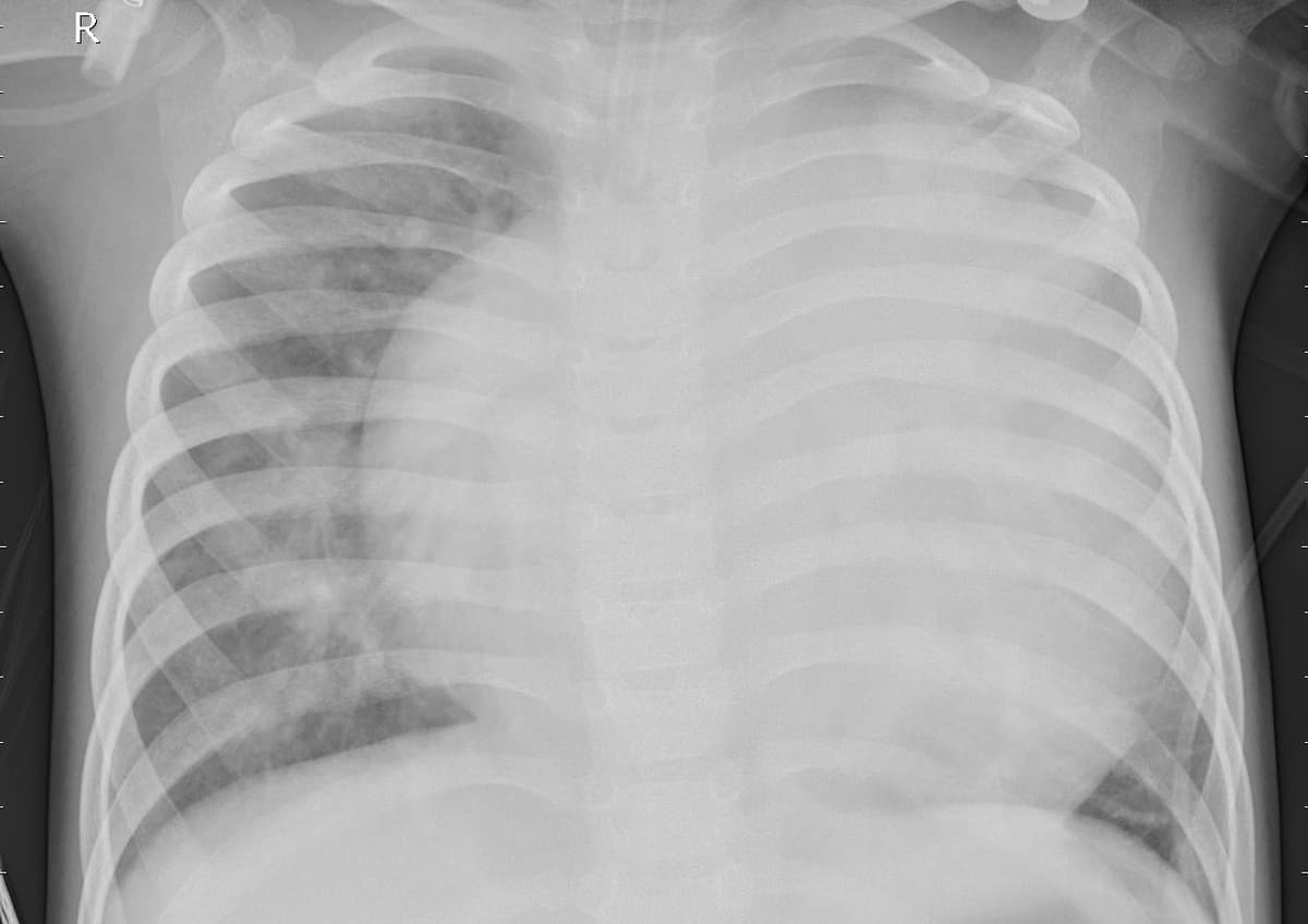 Pneumonia — NIH Chest X-ray14