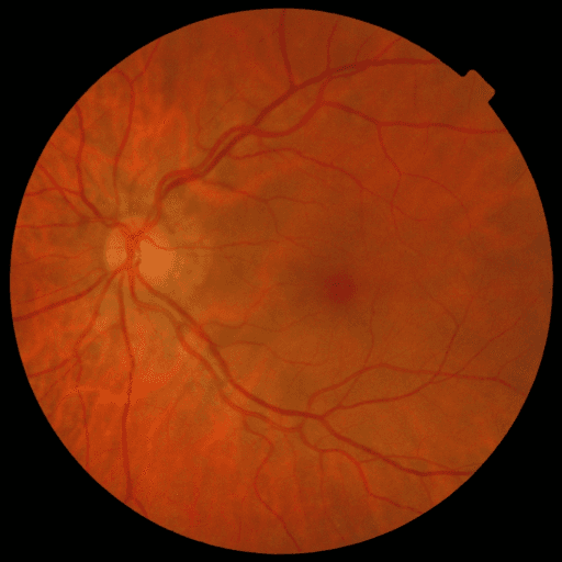 No Diabetic Retinopathy — MESSIDOR-2