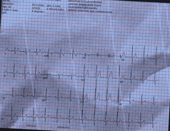 Normal ECG — PTB-XL