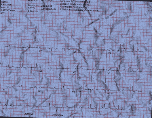 Normal ECG — PTB-XL