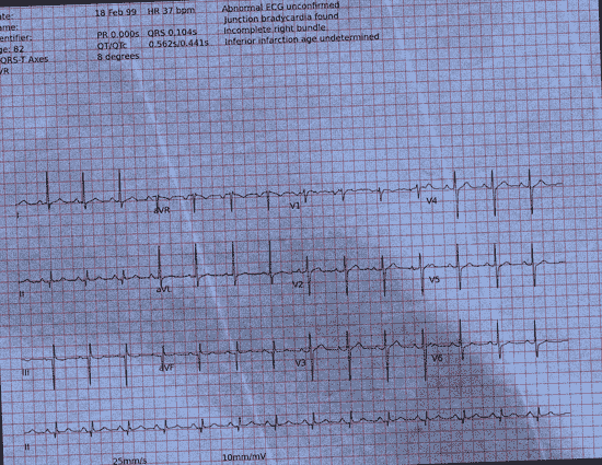 Normal ECG — PTB-XL