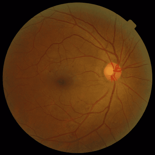 No Diabetic Retinopathy — MESSIDOR-2