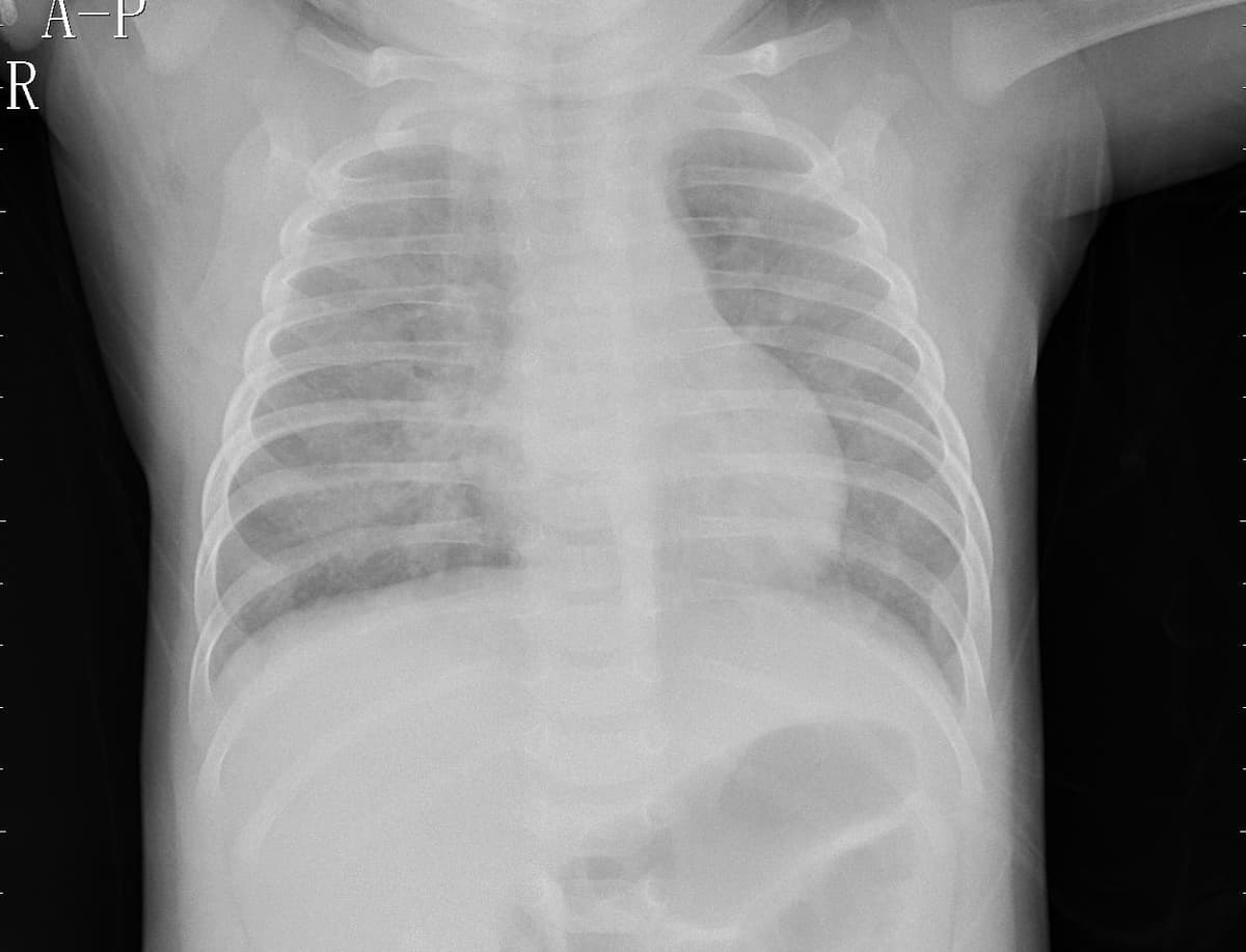 Pneumonia — NIH Chest X-ray14