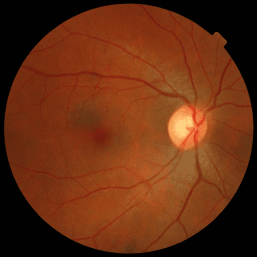 No Diabetic Retinopathy — MESSIDOR-2