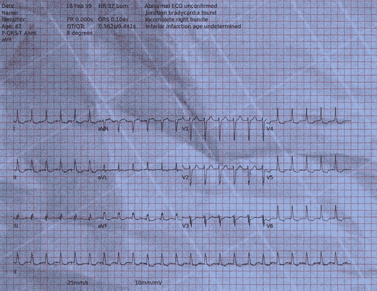 Normal ECG — PTB-XL
