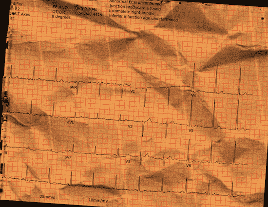 Normal ECG — PTB-XL