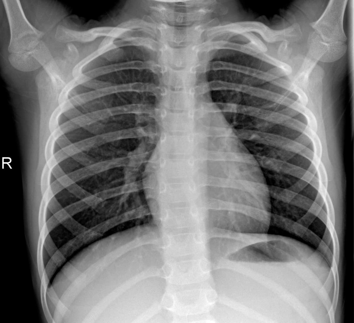 Radiografia Normal — NIH Chest X-ray14