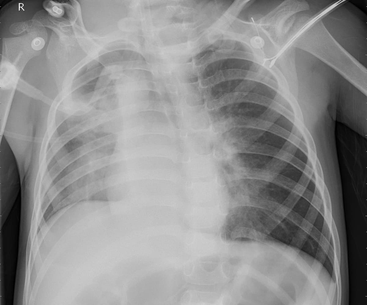 Pneumonia — NIH Chest X-ray14