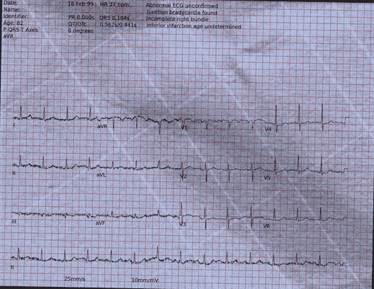Normal ECG — PTB-XL