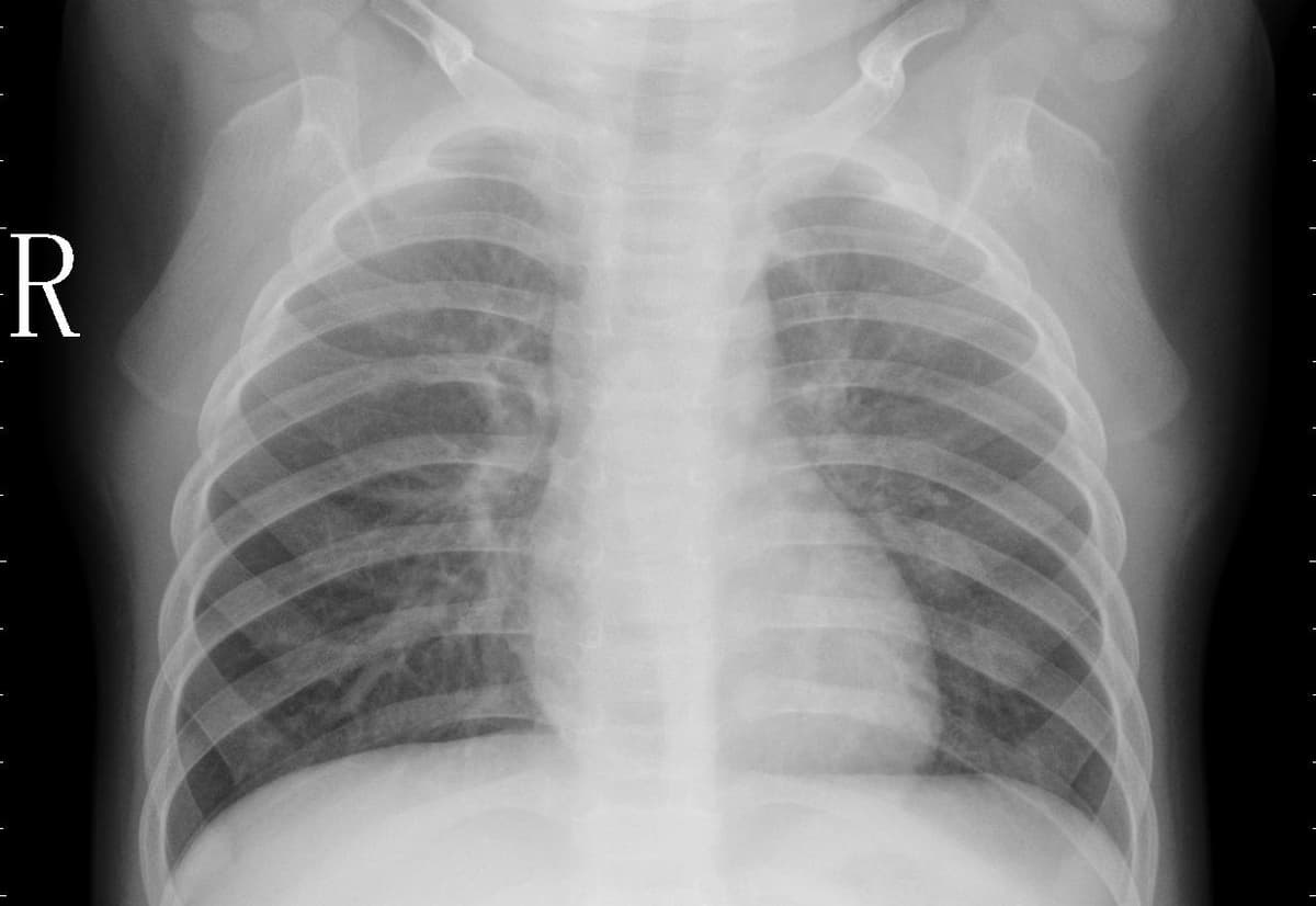 Pneumonia — NIH Chest X-ray14