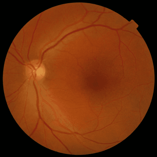 No Diabetic Retinopathy — MESSIDOR-2