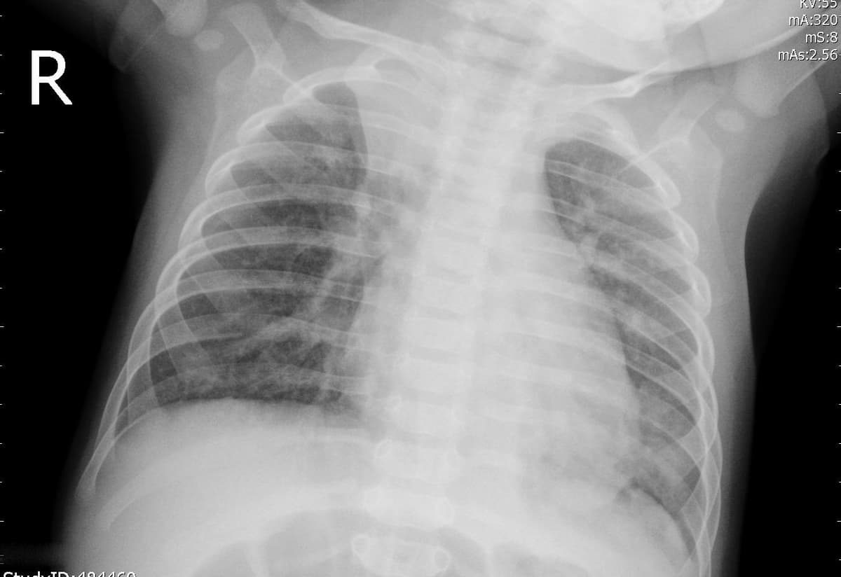 Pneumonia — NIH Chest X-ray14