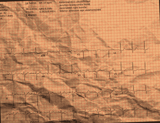 Normal ECG — PTB-XL