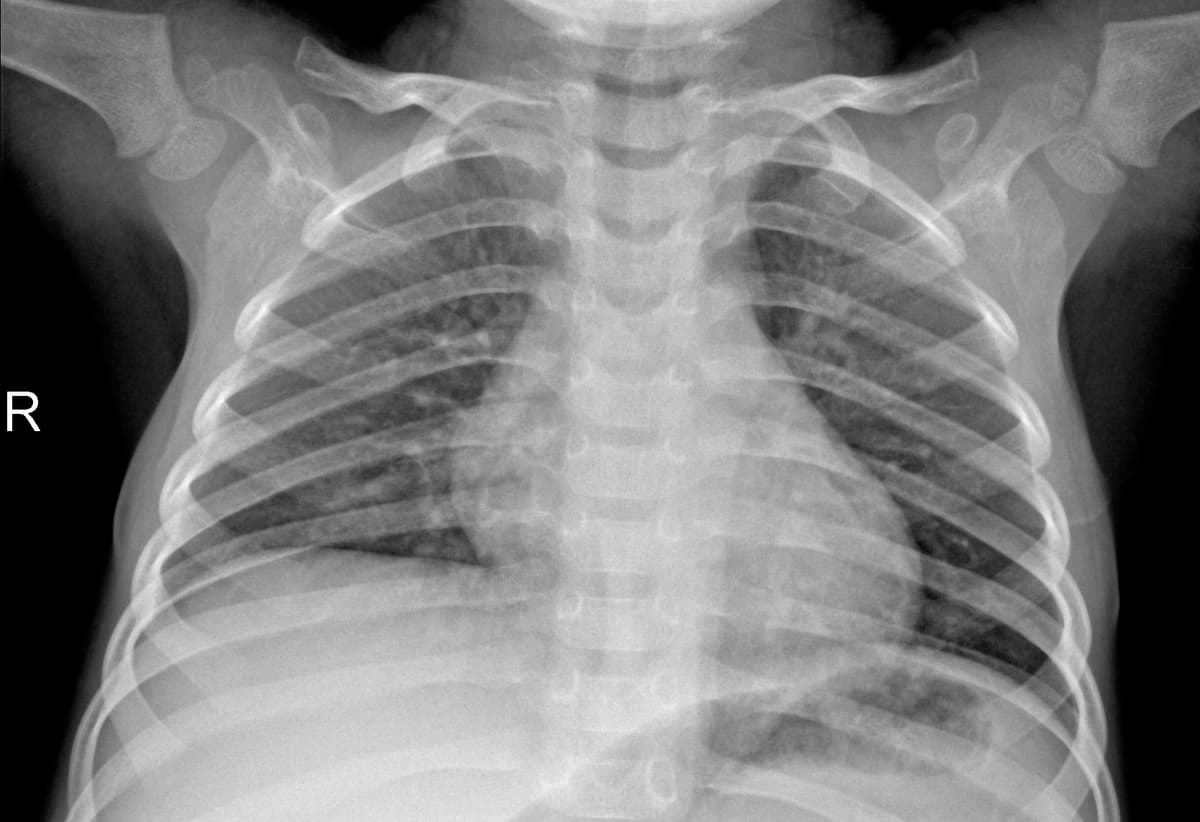 Radiografia Normal — NIH Chest X-ray14