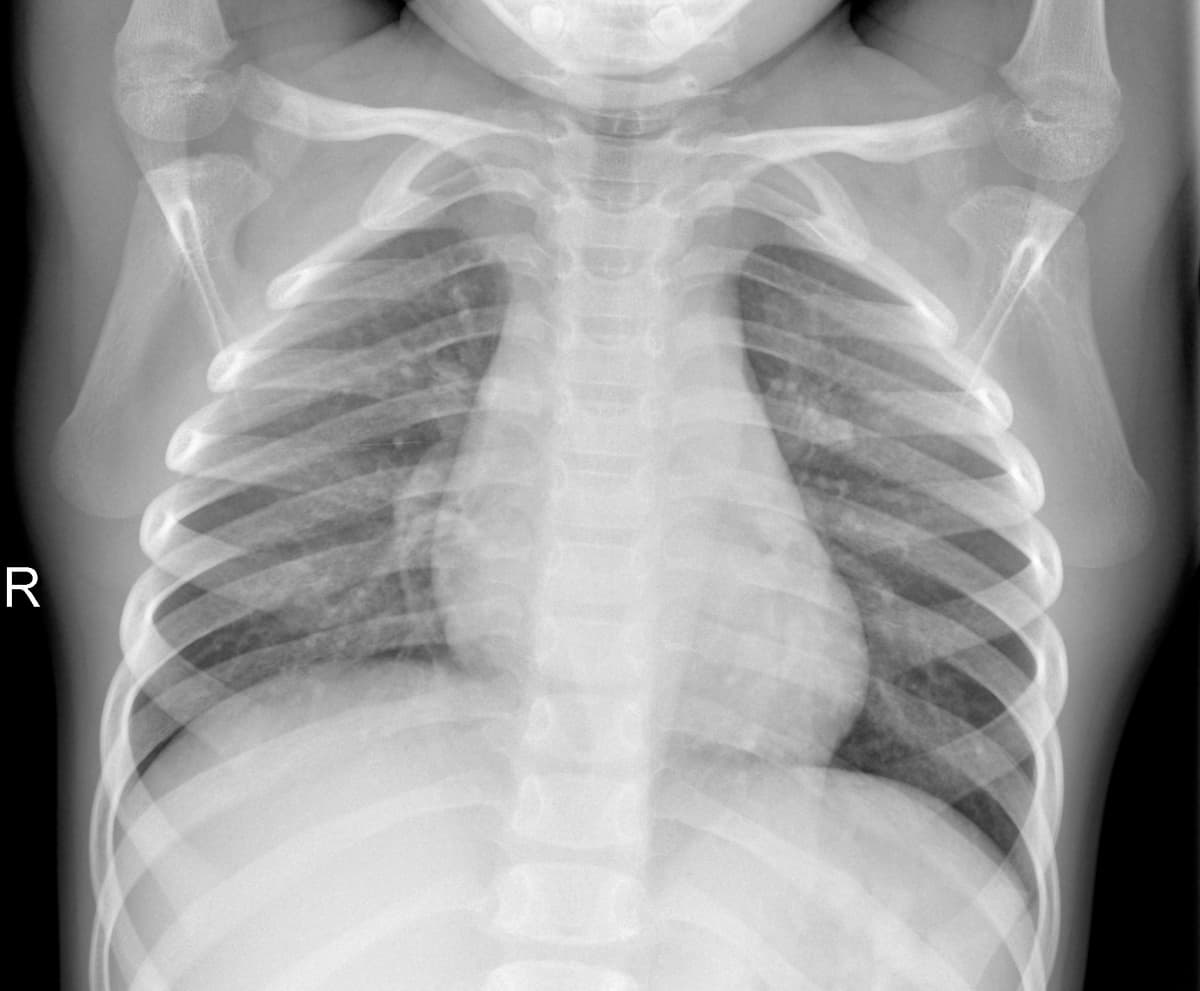 Radiografia Normal — NIH Chest X-ray14