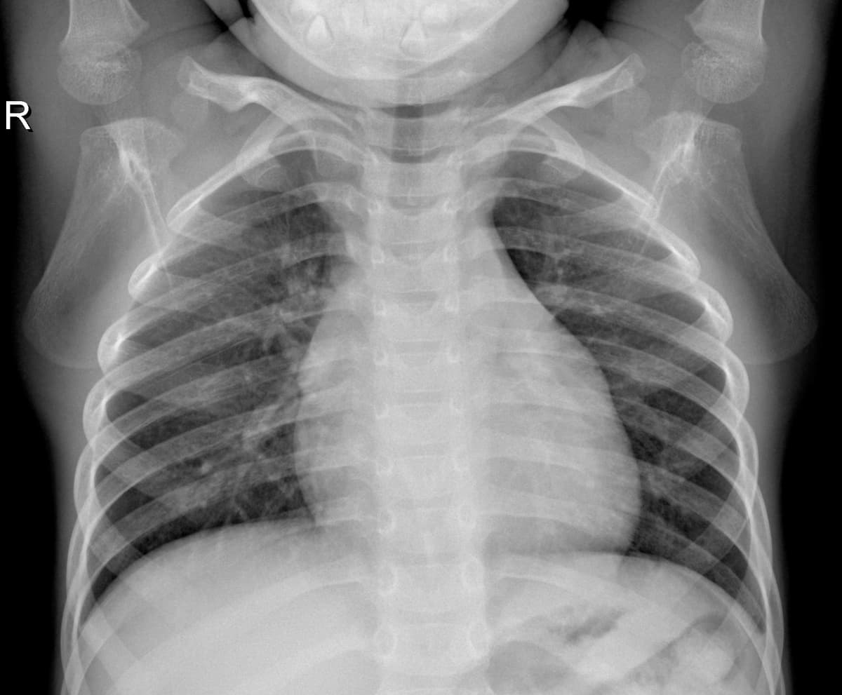 Radiografia Normal — NIH Chest X-ray14