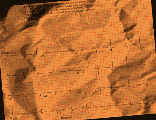 Normal ECG — PTB-XL