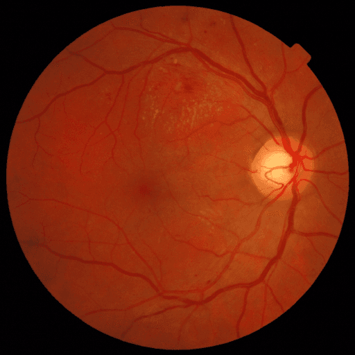 No Diabetic Retinopathy — MESSIDOR-2