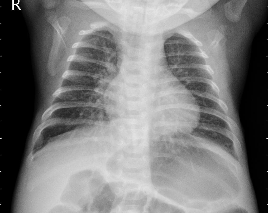Pneumonia — NIH Chest X-ray14