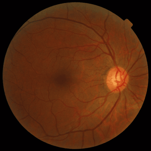 No Diabetic Retinopathy — MESSIDOR-2
